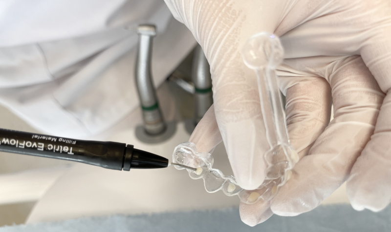 Figure 4 Préparation des attachements orthodontiques