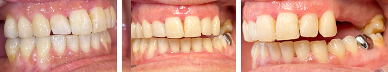 Figure 5 (a) Situation après alignement de 7,5 mois