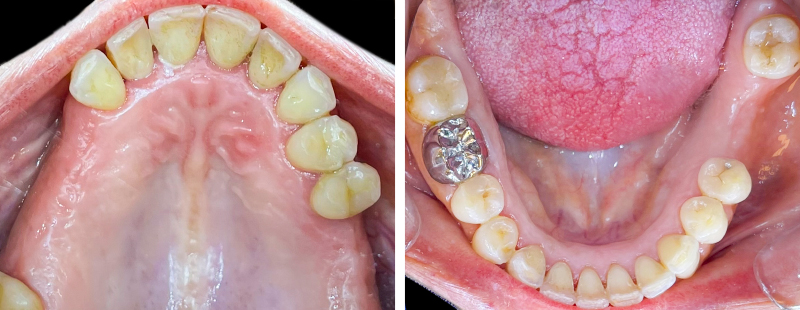5-2Figure 5 (b) Situation après alignement de 7,5 mois