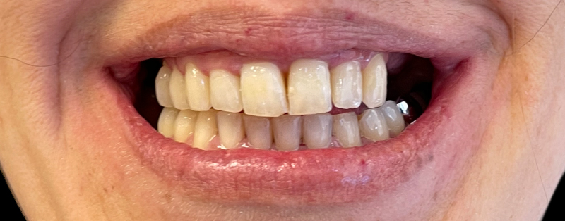 Figure 5 (c) Situation après alignement de 7,5 mois