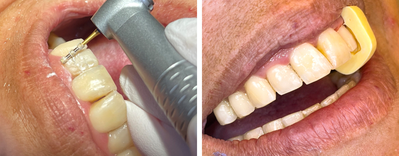 Figure 7 (a) Réalisation d’une facette sur 22