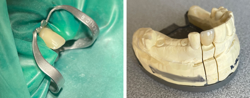 Figure 7 (b) Réalisation d’une facette sur 22