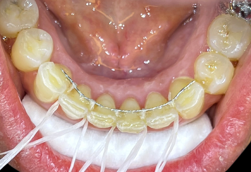 8-imgFigure 8 Contention collée - Traitement réhabilitation
