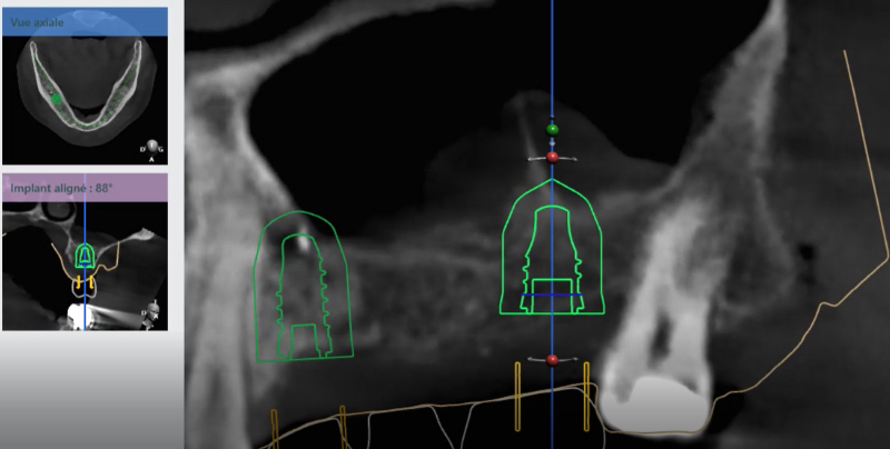 Figure 9 Planification traitement implantaire sur cône beam