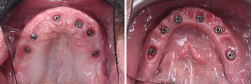 Cicatrisation des tissus suite au provisoire