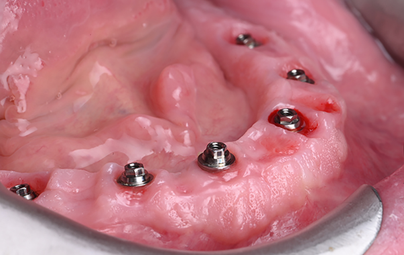 Cicatrisation des tissus suite au provisoire