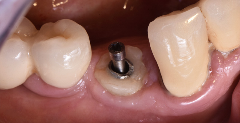 Fig-14-Linda-Martin-44-GC-France