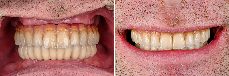 Prothèse d'usage en place