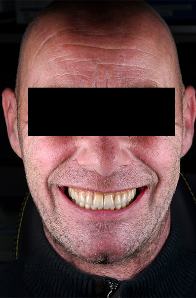 Cicatrisation des tissus suite au provisoire