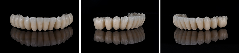 Réalisation de la prothèse d'usage barre titane et dents montées en résine usinée