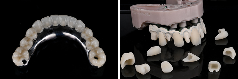 Réalisation de la prothèse d'usage barre titane et dents montées en résine usinée