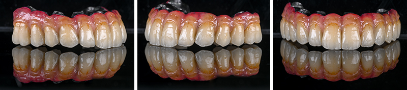 Réalisation de la prothèse d'usage barre titane et dents montées en résine usinée