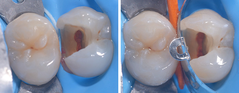 fig-02-voco-restauration