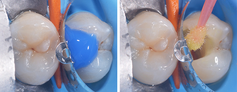 fig-03-voco-restauration