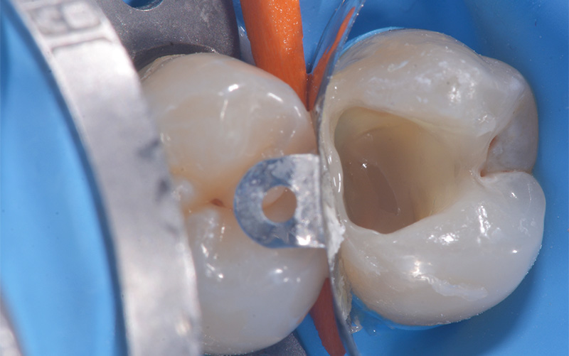 fig-05-voco-restauration-composite-injecte