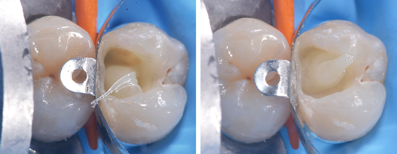 fig-06-voco-restauration-composite-injecte