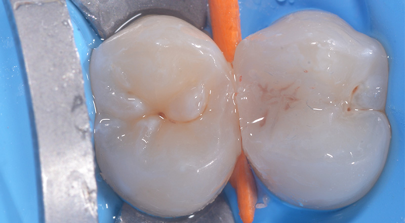 fig-07-voco-restauration-composite-injecte