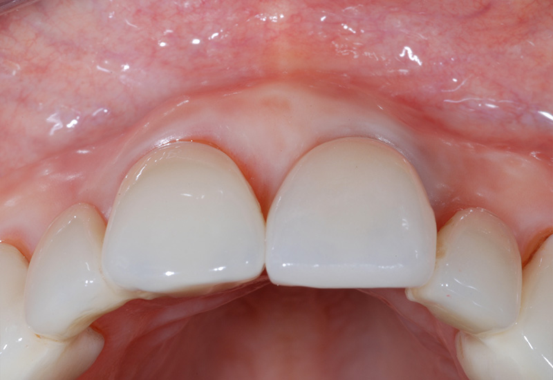 Resultat fenestration 1 an post-opératoire