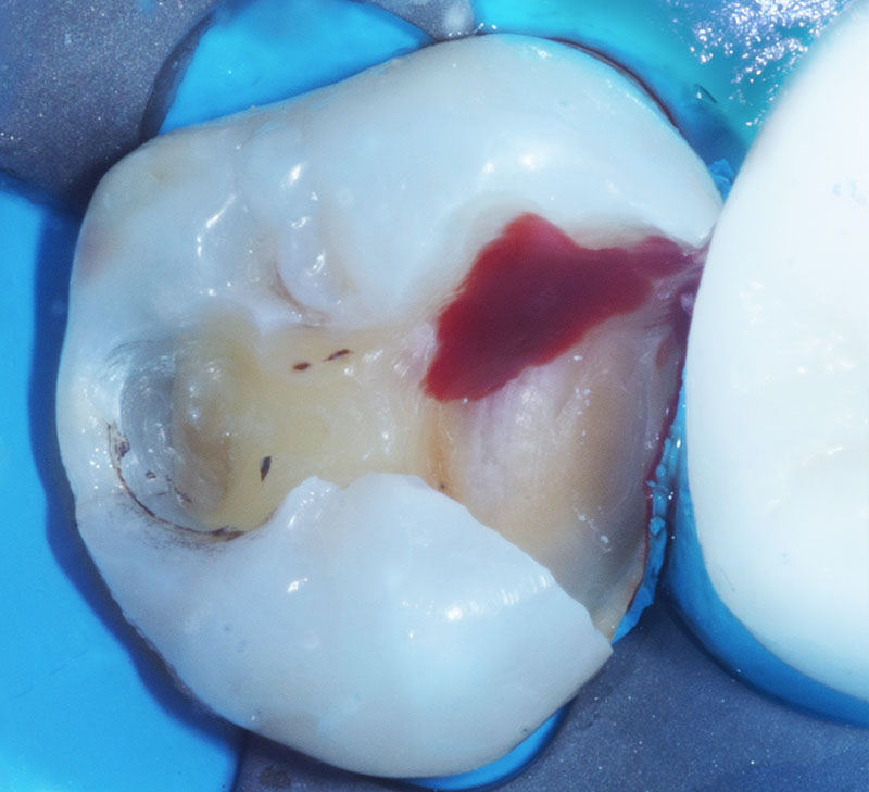 fig-02-dentisterie-adhésive