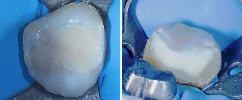 fig-05-dentisterie-adhésive
