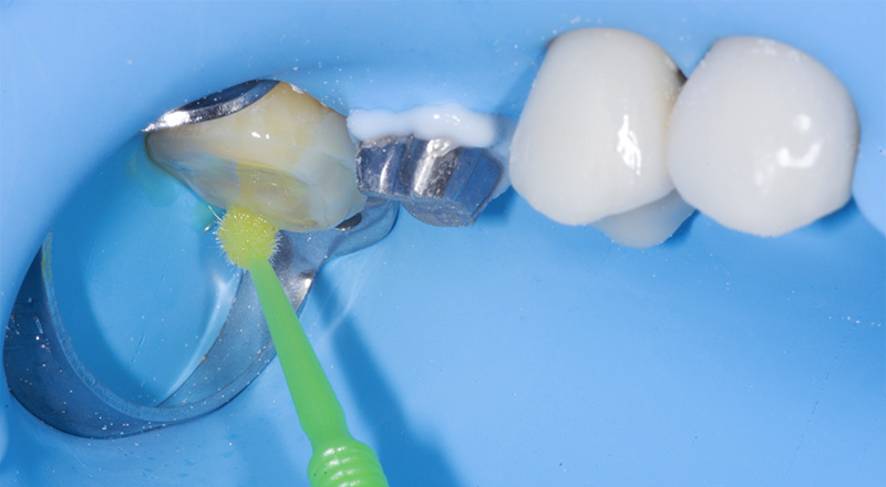 fig-11-dentisterie-adhésive