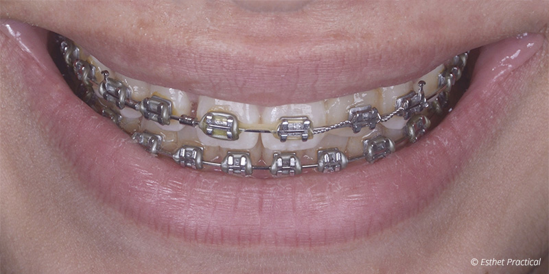 fig-01-bridge-cantilever-toledano