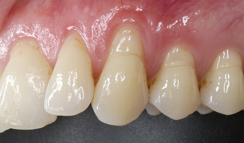 fig-01-tunnel-modifié-collets-récessions