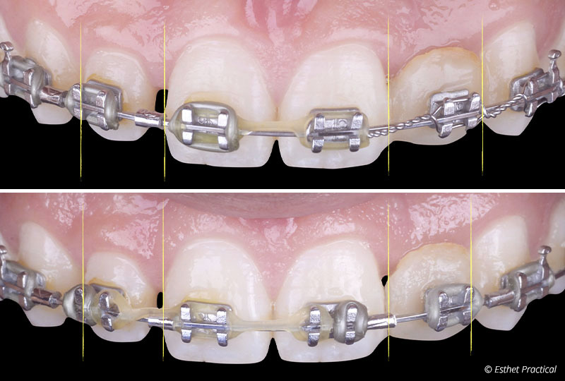 fig-02-bridge-cantilever-toledano