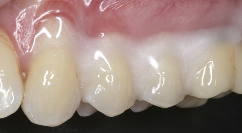 fig-02-tunnel-modifié-collets-récessions