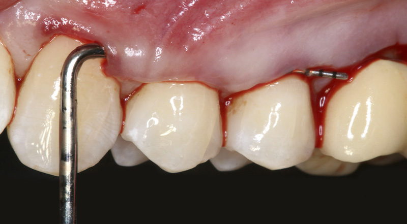 fig-03-tunnel-modifié-collets
