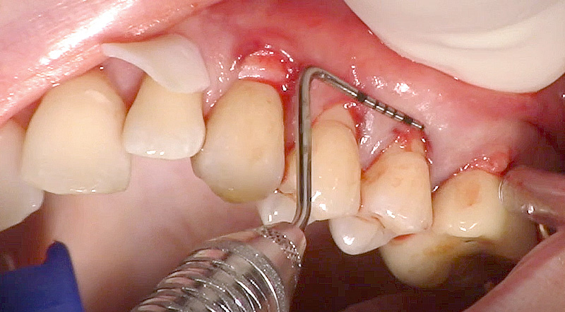 fig-05-tunnel-modifié-collets