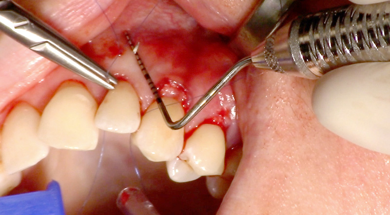 fig-06-tunnel-modifié-collets