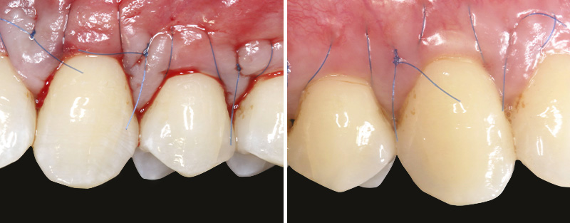 fig-07-tunnel-modifié-collets