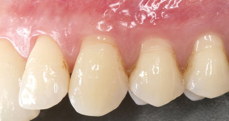 fig-08-tunnel-modifié-collets