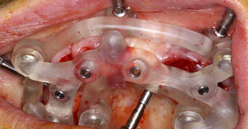 fig-18-guides-étages-luc-sebaoun