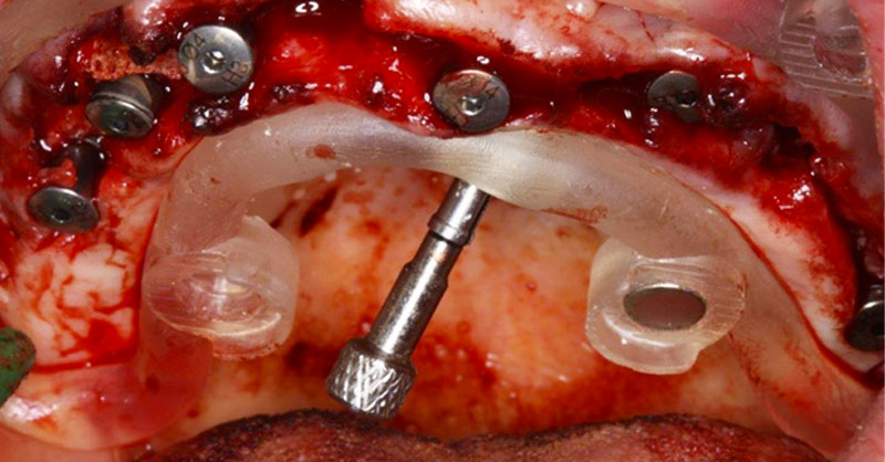 fig-21-guides-étages-luc-sebaoun