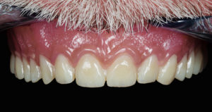 essayage de la prothèse-impression 3D