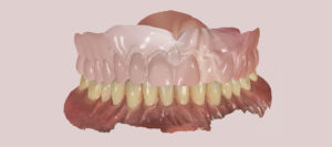 empreinte optique de la PAC modifiée et de l’arcade antagoniste-impression 3D