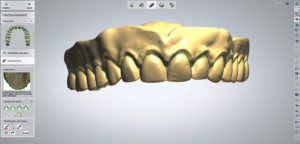 individualisation des dents-impression 3D