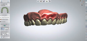 animation de la fausse gencive-impression 3D