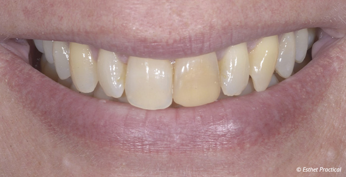 fig01-toledano-composite-stratifié