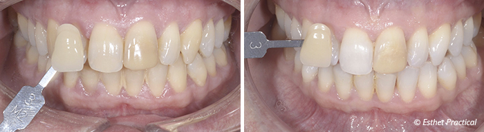 fig02-toledano-composite-stratifié