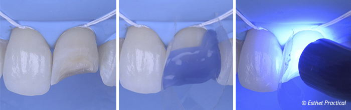 fig05-toledano-composite-stratifié