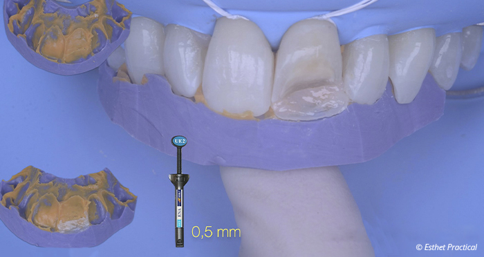 fig06-toledano-composite-stratifié