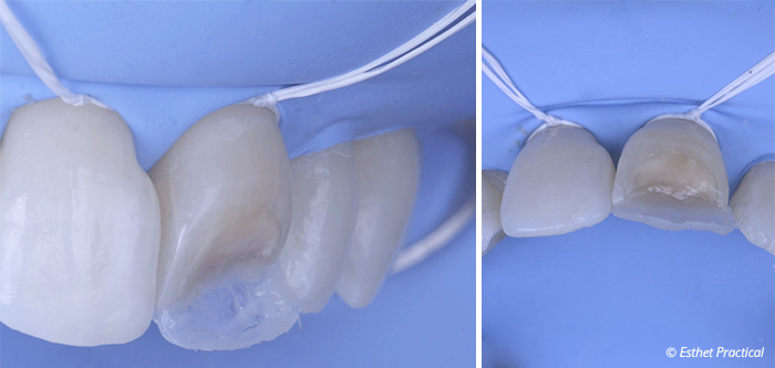fig08-toledano-composite-stratifié