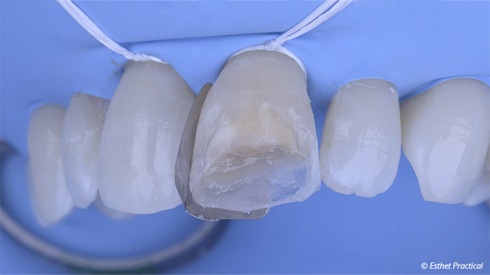 fig09-toledano-composite-stratifié