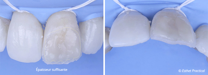 fig13-toledano-composite-stratifié
