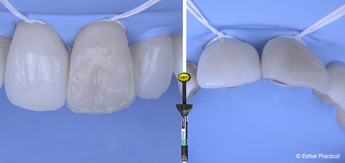 fig14-toledano-composite-stratifié