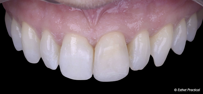 fig21-toledano-composite-stratifié