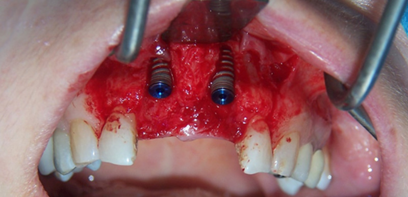 fig-06-article-Jonathan-Amar-extraction